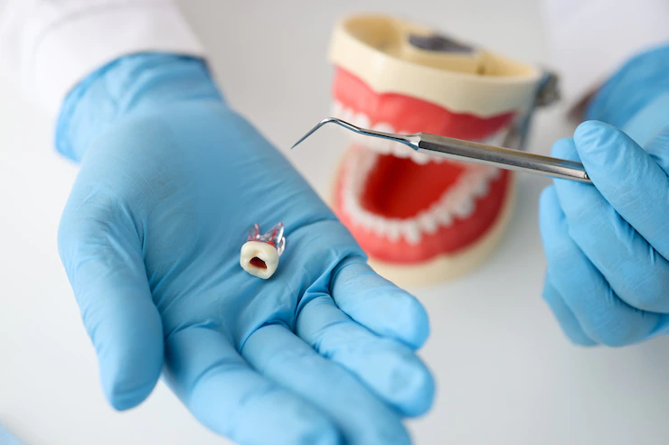Advantages Of Root Canal Treatment