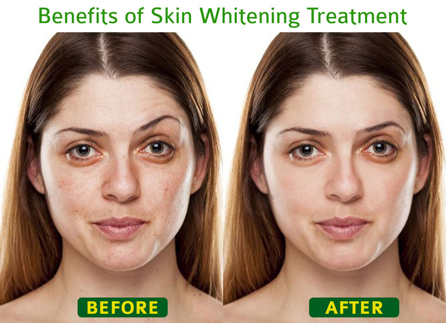 Get rid of patchy skin and dark spots from the skin whitening treatment in Gurgaon. The best skin specialist in town will look after your skin to beautify it.
