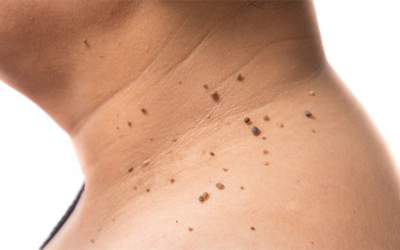Removing Mole & Skin Tags by Laser